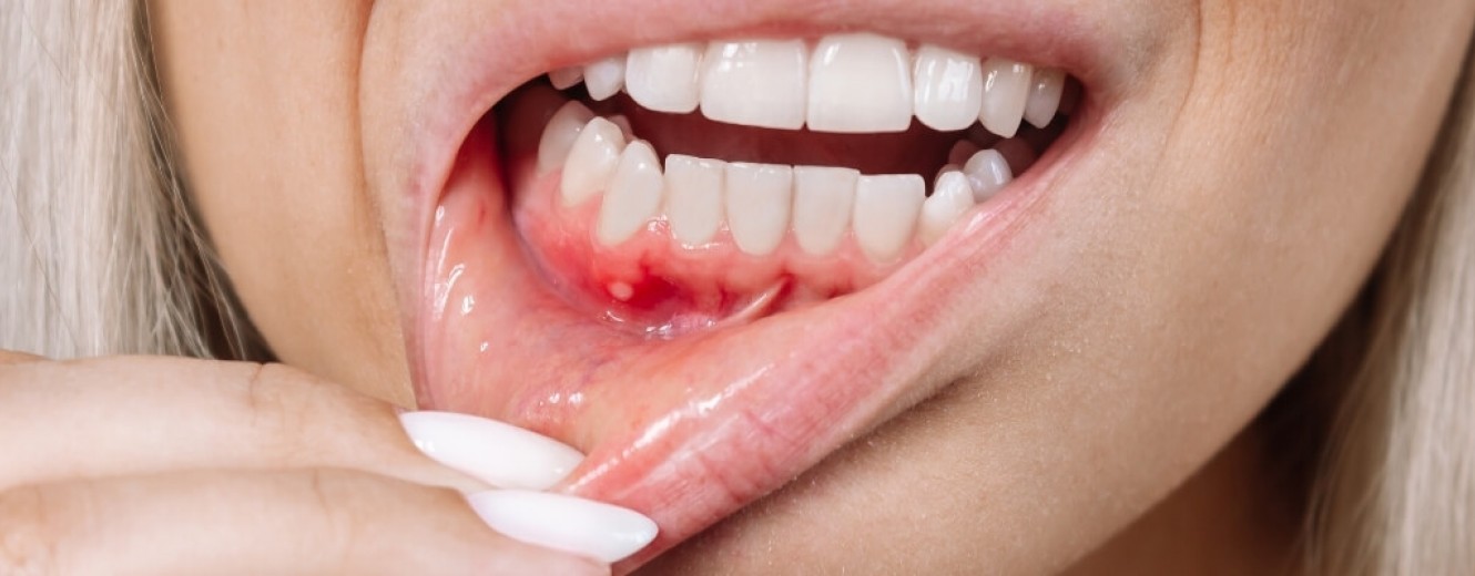 Diş Eti Hastalıkları