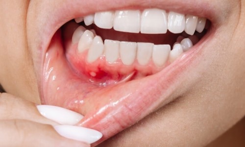 Diş Eti Hastalıkları