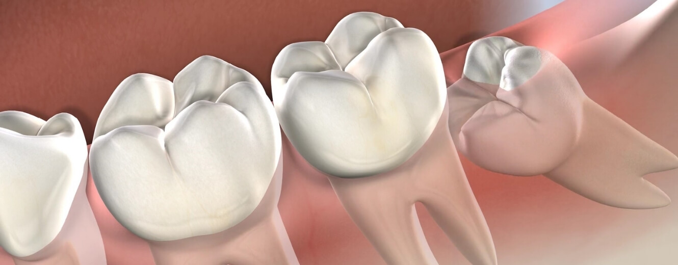 Cevatpaşa’da Gömülü 20’lik Diş Çekimi