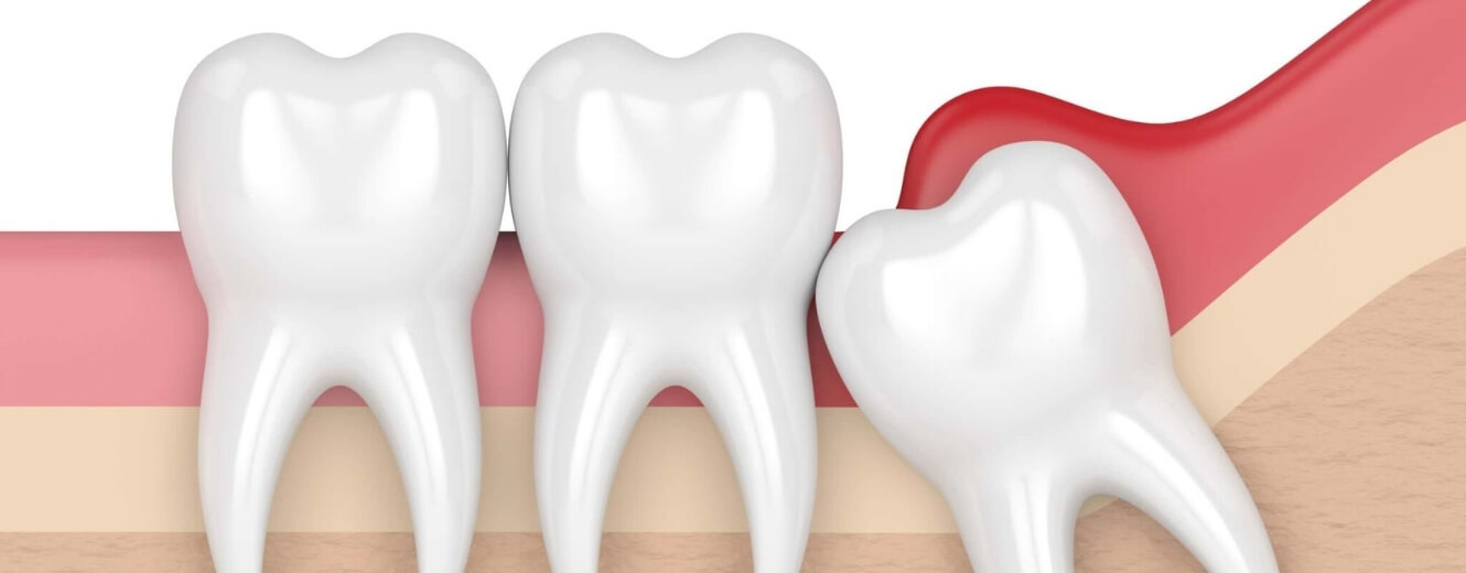 Bayrampaşa’da 20’lik Diş Çekimi