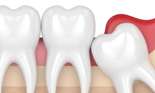 Küçükköy’de 20’lik Diş Çekimi