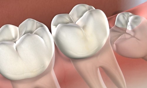 Cevatpaşa’da Gömülü 20’lik Diş Çekimi