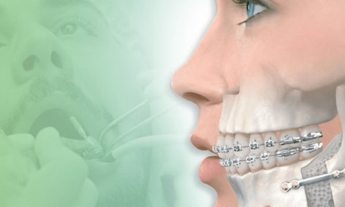 Bayrampaşa'da Çene Kırıkları ve Tedavi Süreci