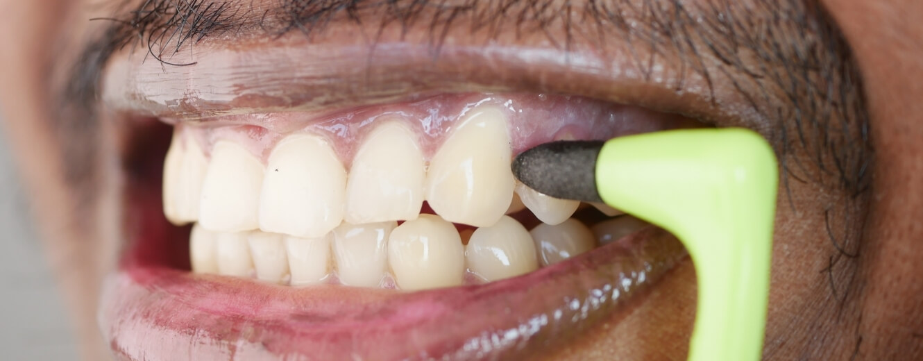 Kocatepe Diş Beyazlatma