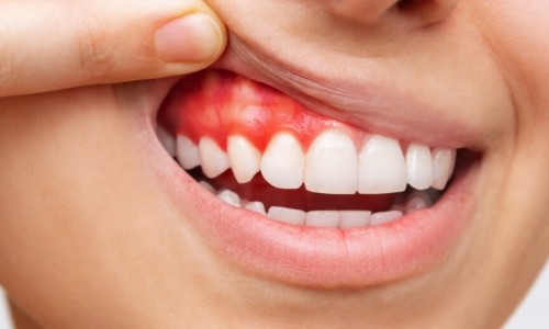 Diş Eti Hastalıkları Nasıl Önlenir ve Tedavi Edilir?