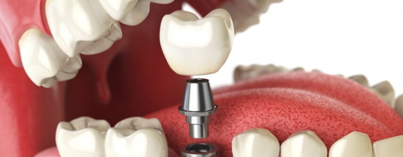 Bayrampaşa Dikişsiz İmplant Tedavisi Mümkün mü?