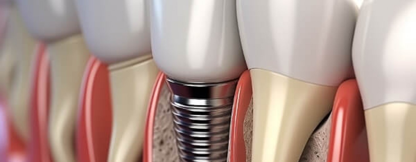 Beşyüzevler'de İmplant Güncel Bilgiler ve Tedavi Süreci