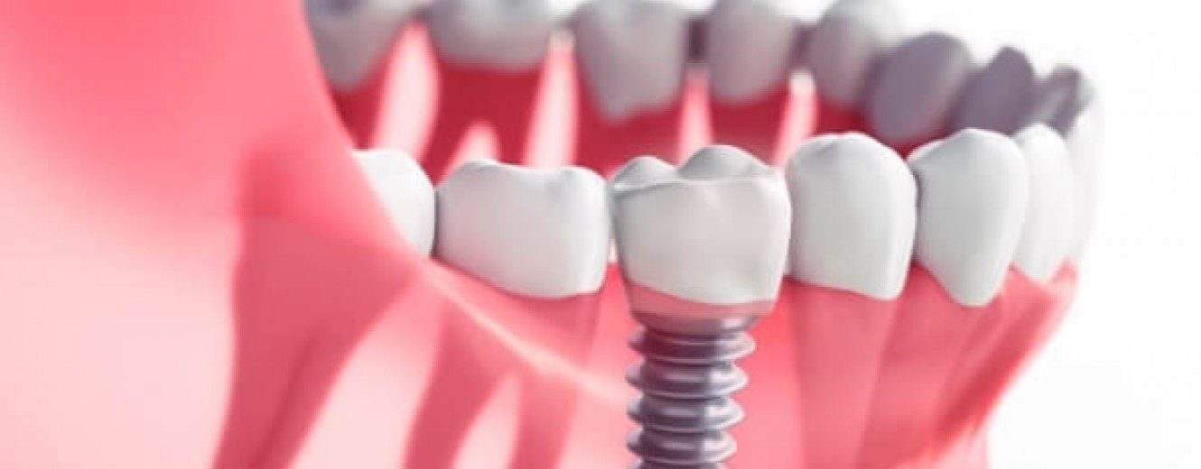 İmplant Tedavisinde Hangi Malzemeler Kullanılır?