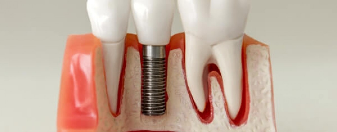 Diş Eksikliklerinde İmplant mı, Köprü mü Daha Avantajlı?