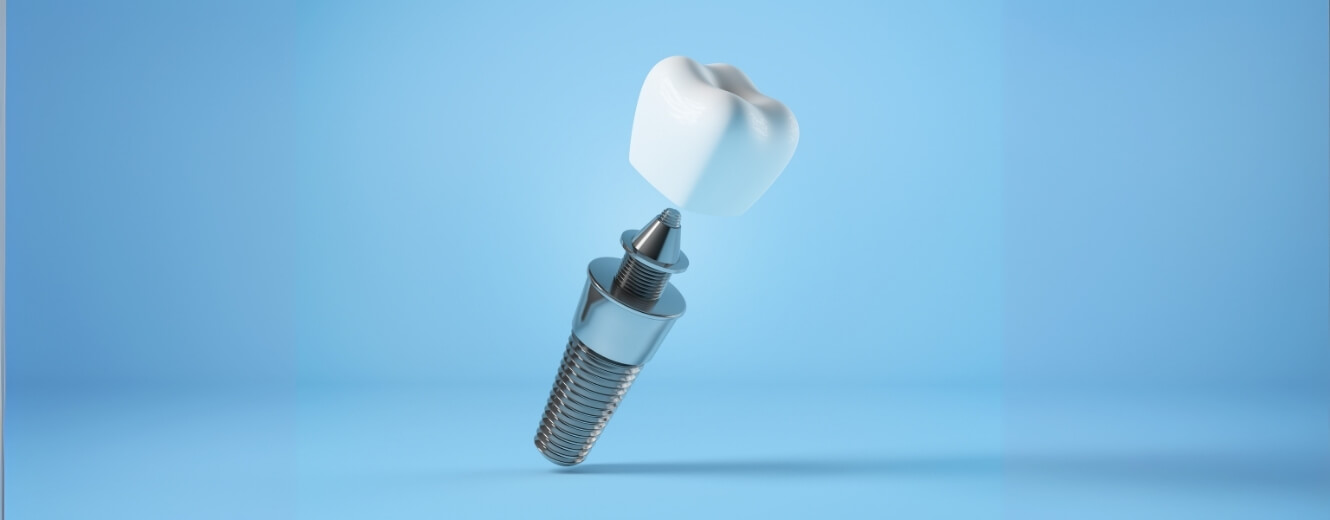 İmplant Sonrası Nelere Dikkat Edilmelidir?