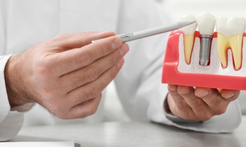 İmplant Nedir ? Kimler İçin Uygundur ?