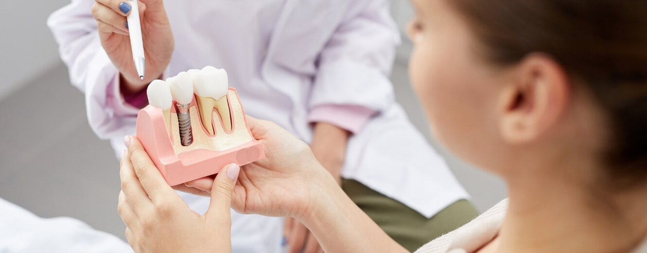 İmplant Diş Tedavisi Ne Kadar Sürer?