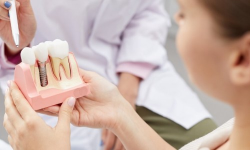 İmplant Diş Tedavisi Ne Kadar Sürer?