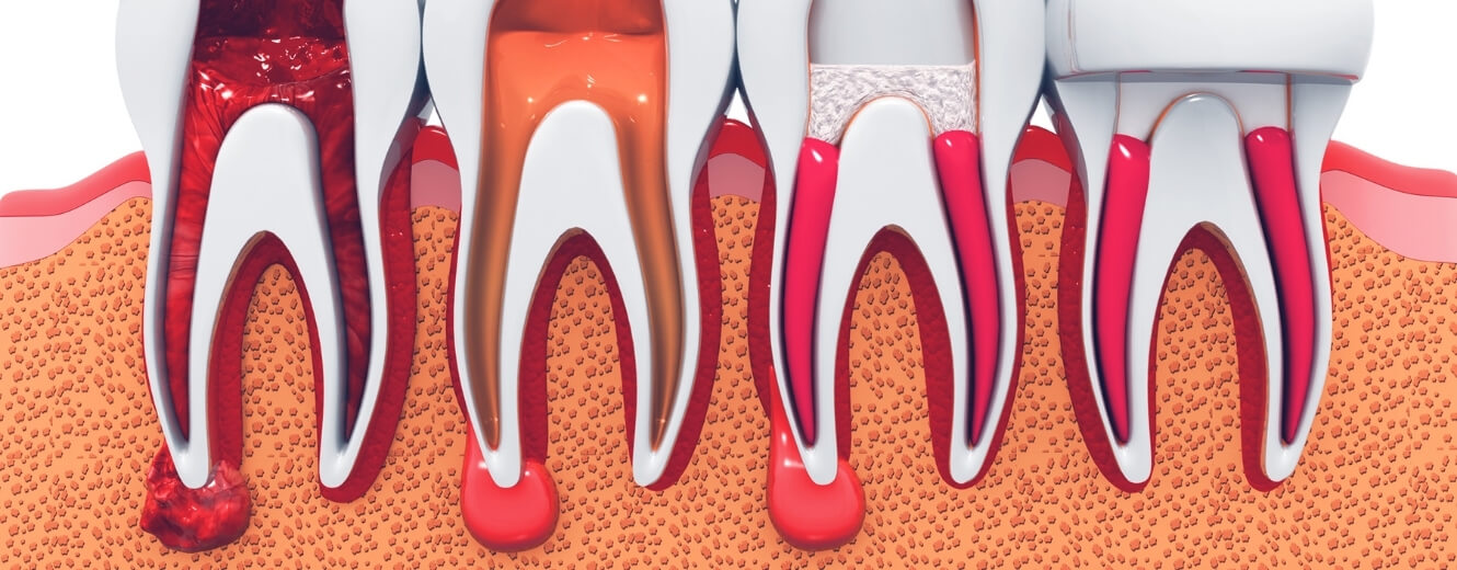 Kanal Tedavisi Ne Zaman Gereklidir?