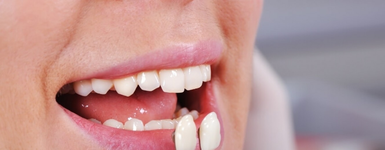 Beşyüzevler’de Porselen Diş Kaplama Ne Kadar Dayanıklıdır? Beşyüzevler’de Porselen Diş Kaplama Ne Kadar Dayanıklıdır?