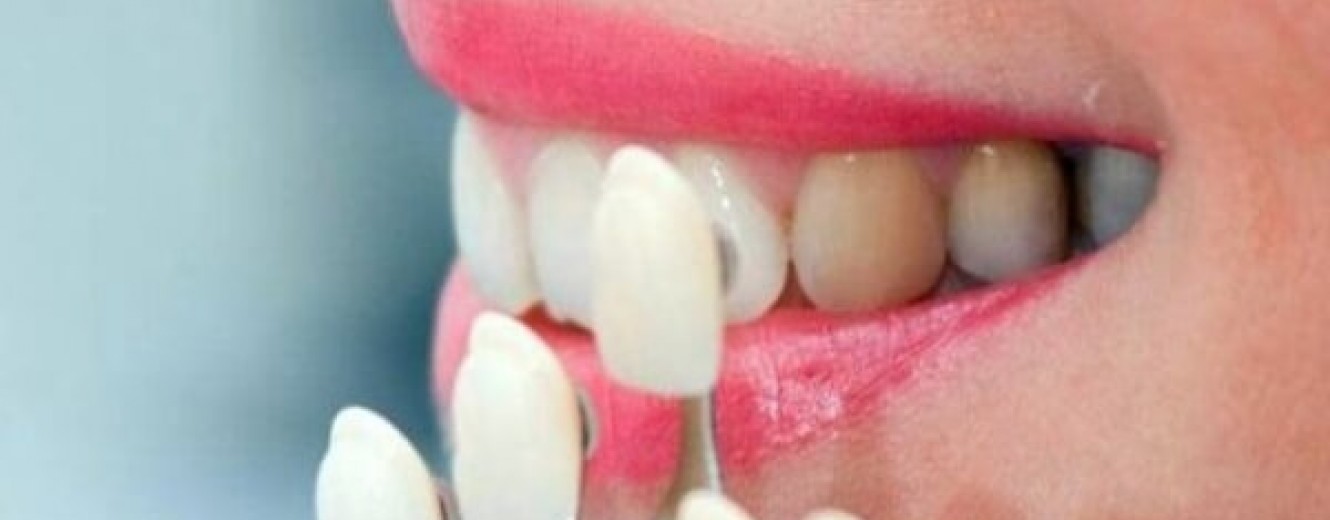Bayrampaşa’da Diş Estetiğinde Porselen Kaplama mı, Lamina mı Tercih Edilmeli?