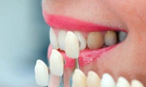 Bayrampaşa’da Diş Estetiğinde Porselen Kaplama mı, Lamina mı Tercih Edilmeli?