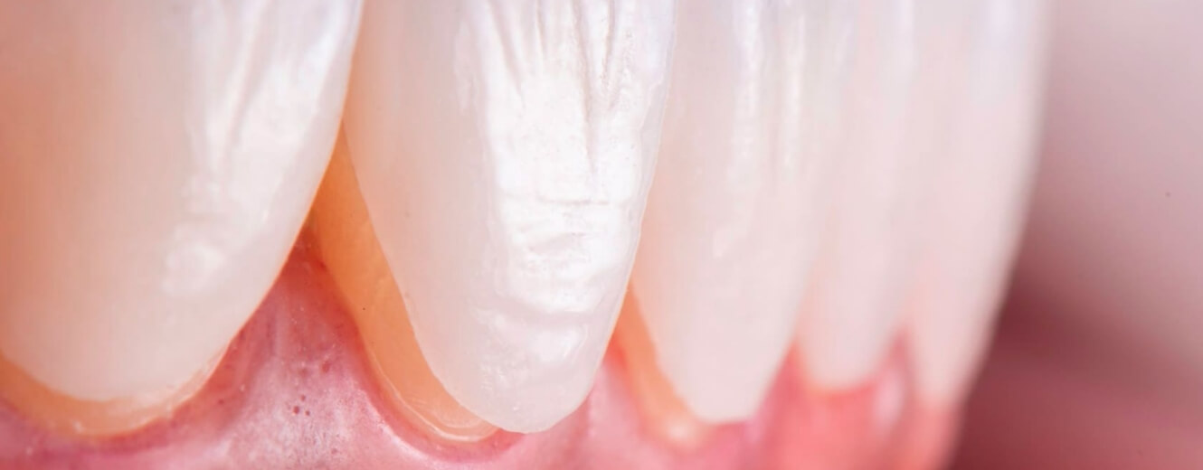 Lamina Kaplama Sonrası Diş Bakımı Nasıl Yapılmalı? Lamina Kaplama Sonrası Diş Bakımı Nasıl Yapılmalı?