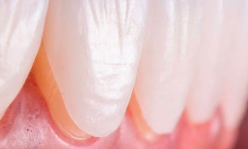 Lamina Kaplama Sonrası Diş Bakımı Nasıl Yapılmalı?